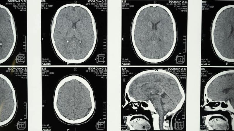 Recherche - Institut Robert-Debré du Cerveau de l’Enfant